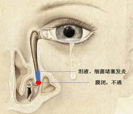 老是莫名奇妙流眼泪？小心眼球旁的“潜伏炸弹”！